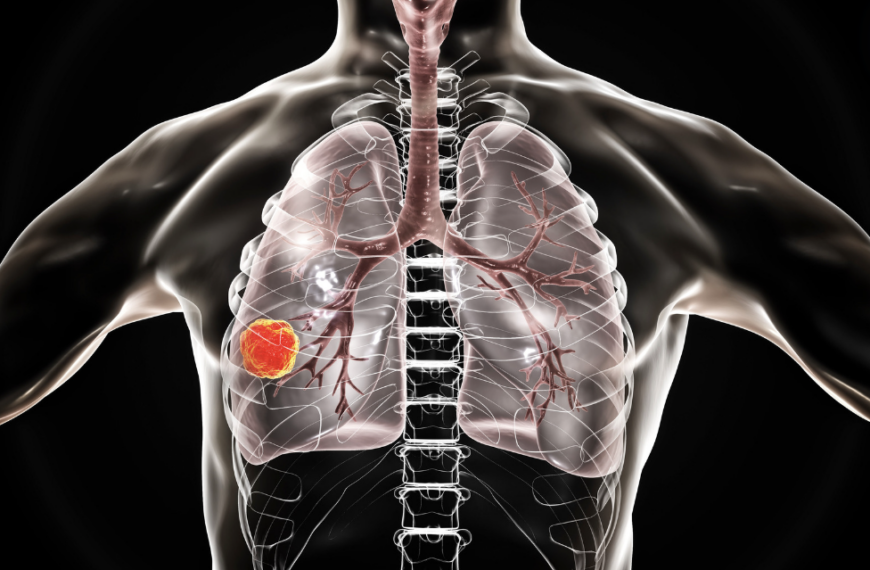 lung cancer